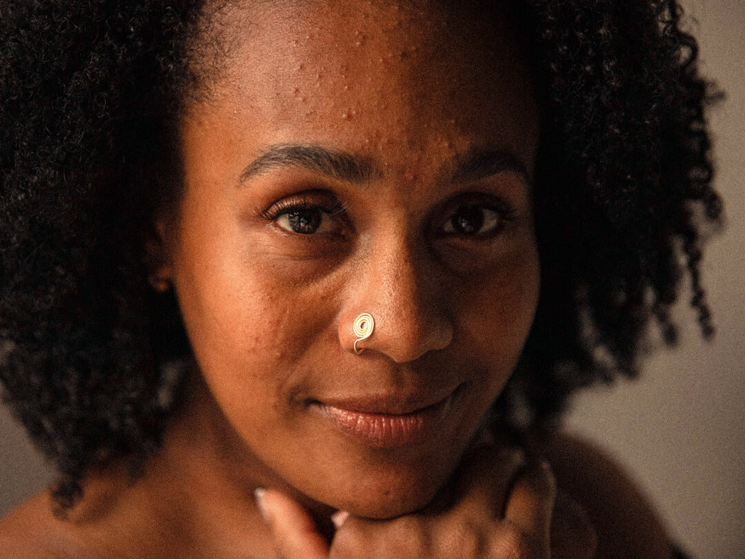 Unreine Haut Hormone